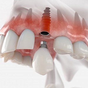 a 3D depiction of a dental implant and restoration