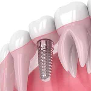Illustration of single dental implant