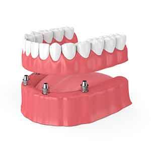 Illustration of implant denture