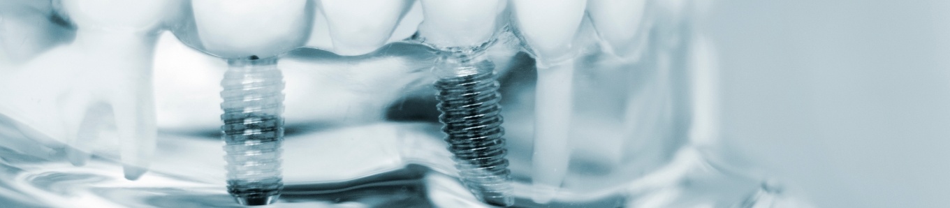 Two dental implants in Centennial in plastic tray