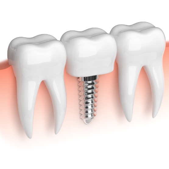 Illustration of dental implant between natural teeth