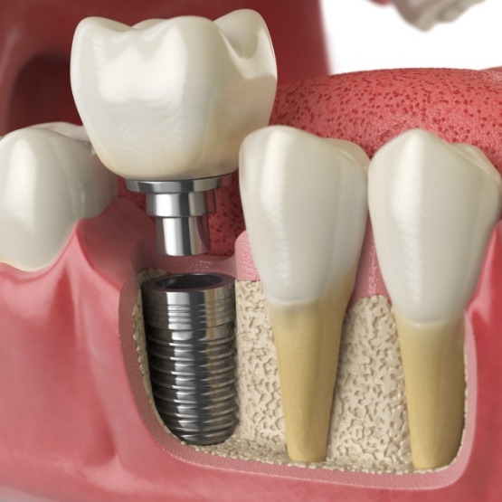 Dental crown being attached to dental implant in jaw