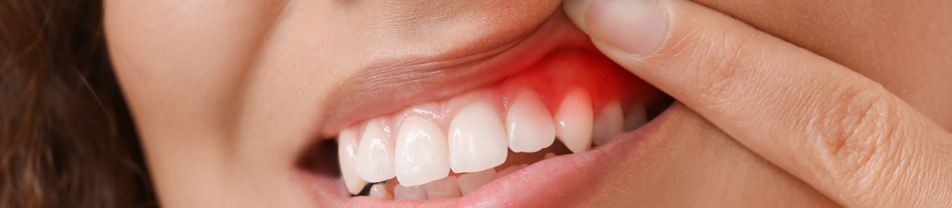 Showing inflamed gums in need of gum disease treatment in Centennial