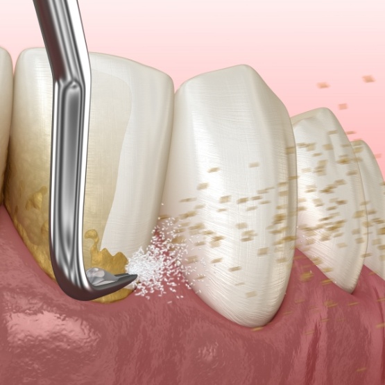 Illustration of dental scaler removing plaque buildup