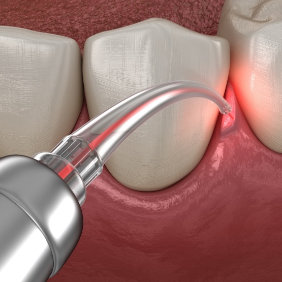 Dental laser treating gum disease