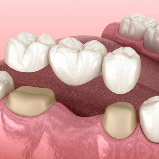 Illustration of a dental bridge attached to natural teeth