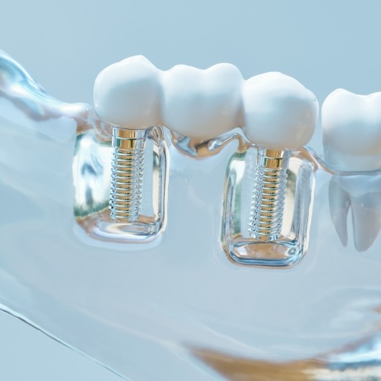 Dental implant bridge in a plastic tray