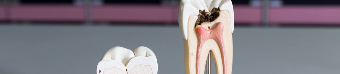 Model of damaged tooth that needs root canal treatment in Centennial