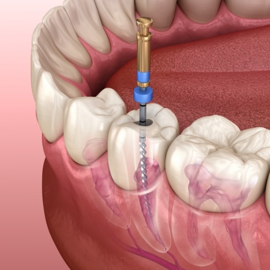 Illustration of dental instrument treating inside of tooth
