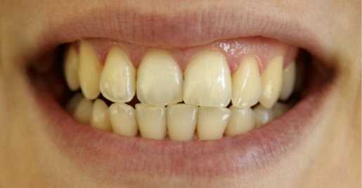 Smile with yellow teeth before dental treatment