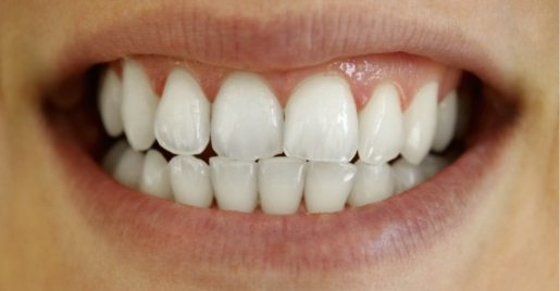 Smile with whiter teeth after dental treatment