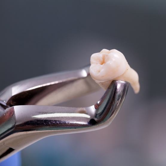 Tooth held by forceps after a tooth extraction